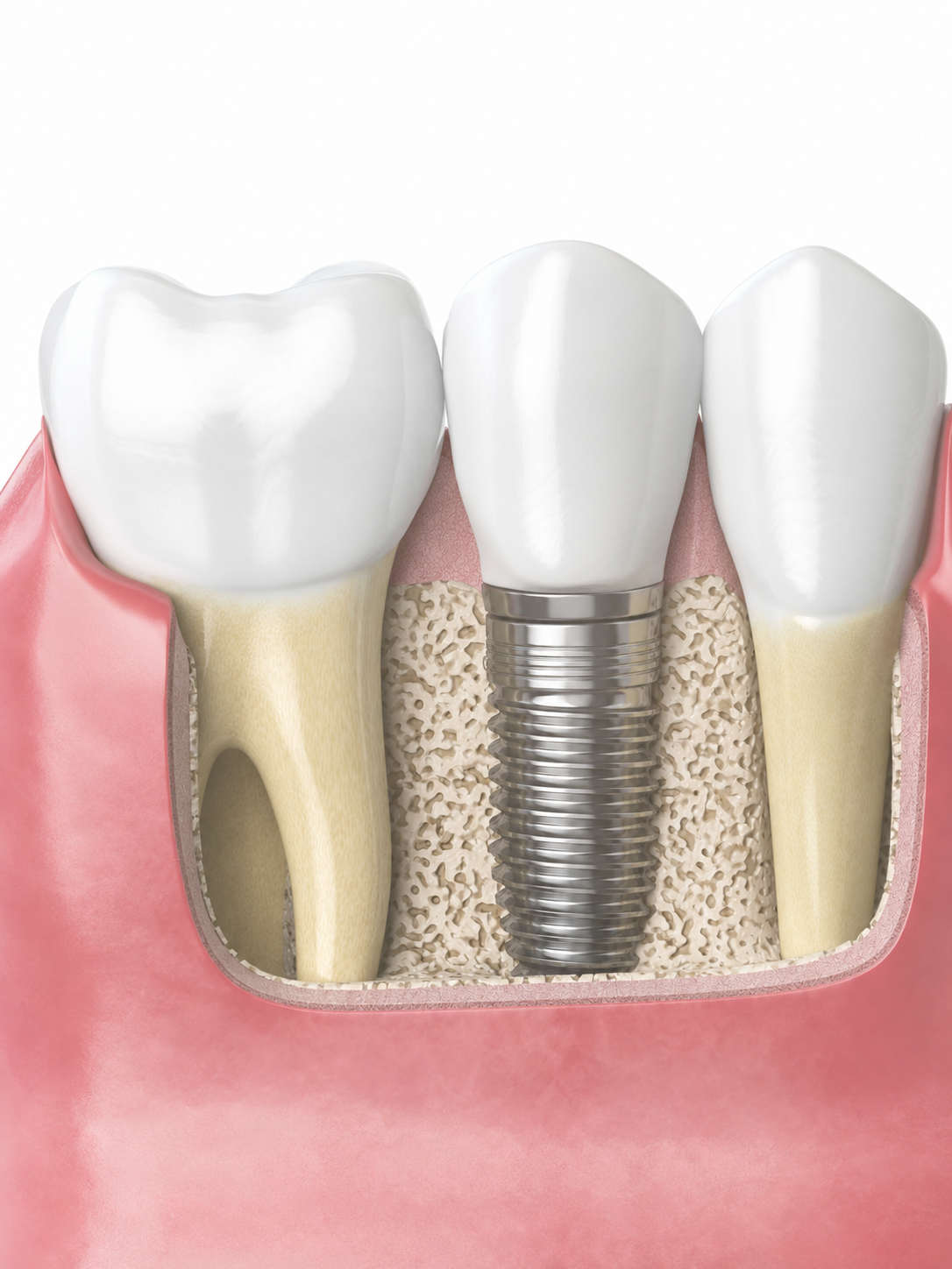 Implantes dentários